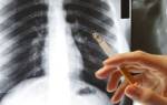 Может ли рентген легких показать курение