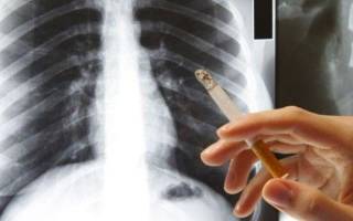 На рентгене легких видно что человек курит