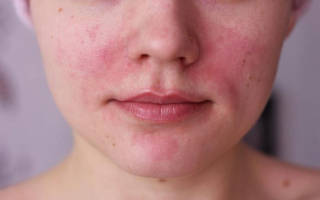 Аллергия на вейп симптомы