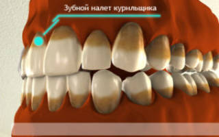 Как отбелить зубы от никотина