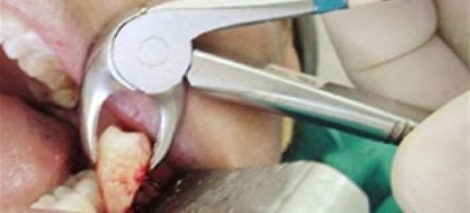 Можно ли покурить после удаления зуба