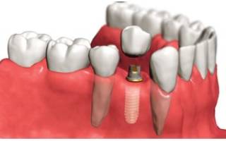 Курение и имплантация зубов: совместимо ли? (отзывы)