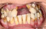 Желтые зубы от курения