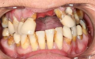 Как отбелить зубы от сигарет