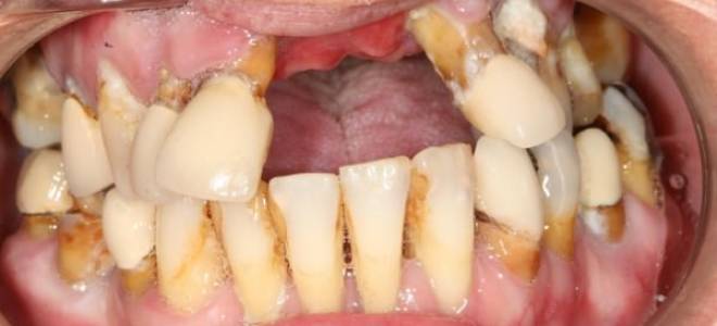 Как отбелить зубы от сигарет