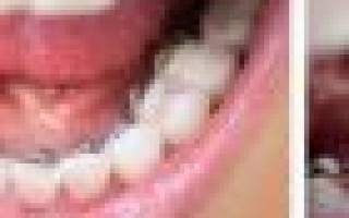Можно ли курить с открытым зубом