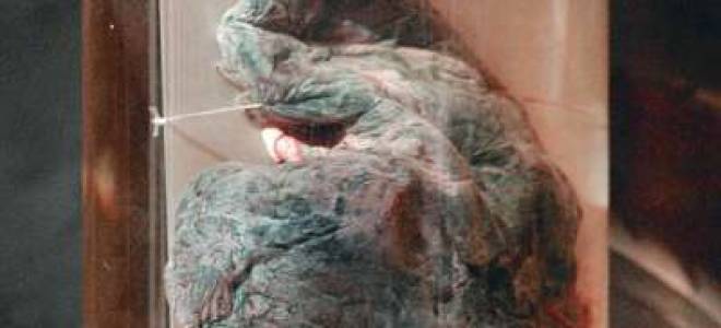 Легкие до и после курения