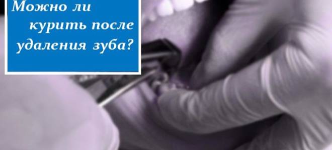 Можно ли курить когда вырвали зуб