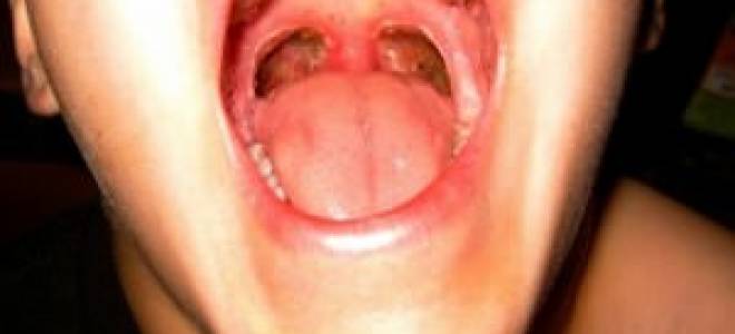 Можно ли при ангине курить сигареты