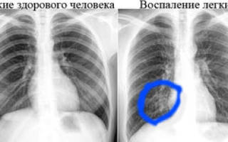 Рентген легких курильщика и здорового человека